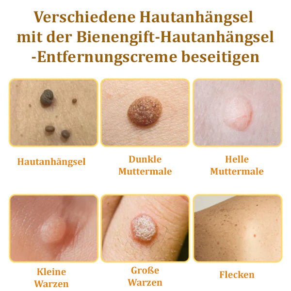 ✅🌟BfArM-zertifizierte | flysmus™ Bienengift-Hautanhängsel-Entfernungscreme👨⚕️
