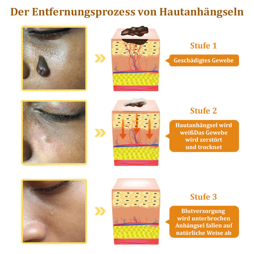 ✅🌟BfArM-zertifizierte | flysmus™ Bienengift-Hautanhängsel-Entfernungscreme👨⚕️