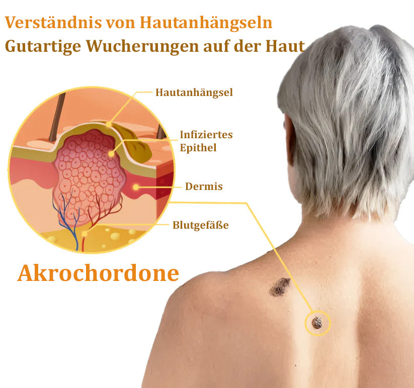✅🌟BfArM-zertifizierte | flysmus™ Bienengift-Hautanhängsel-Entfernungscreme👨⚕️